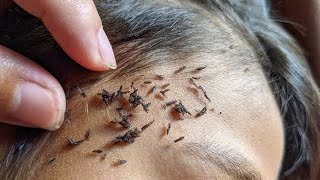 How to Get Rid of Lice Effective Lice Treatment in 3 Steps [upl. by Hullda799]