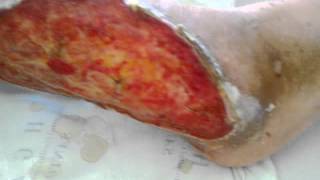 Leg Ulcer venous leg ulcers [upl. by Caressa]