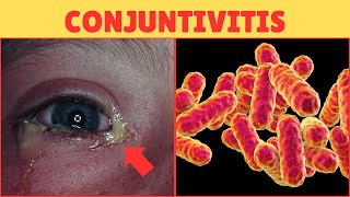 Alerta🚨 Conjuntivitis Bacteriana y Viral sintomas y tratamiento [upl. by Phillip]