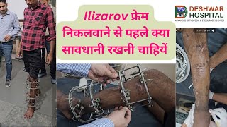 Ilizarov frame निकलवाते समय की सावधानियां Ilizarov stress test Ilizarov [upl. by Zilada]