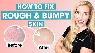 How To Fix Rough and Bumpy Skin  Keratosis Pilaris Affordable Skincare Routine [upl. by Eslehc]