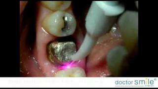 Doctor Smile Dental Laser Diode Surgery [upl. by Ki]