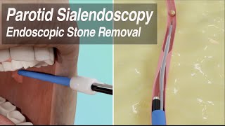 Parotid Sialendoscopy Endoscopic Duct Stenosis Balloon Dilation amp Salivary Stone Removal [upl. by Azaria946]