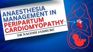 Anaesthesia Management In Peripartum Cardiomyopathy I Dr Nagesh Jambure [upl. by Mert]