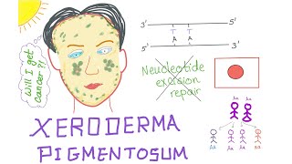 Xeroderma Pigmentosum [upl. by Town]