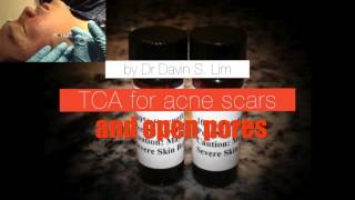 TCA CROSS for enlarged pores and ice pick acne scars [upl. by Aigneis]