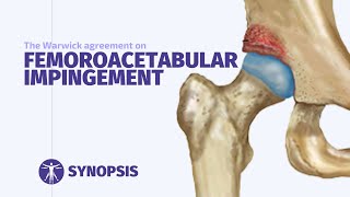 Femoroacetabular Impingement FAI Syndrome  SYNOPSIS [upl. by Armillia]