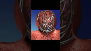 Brain aneurysm non surgery treatment  coiling  Dr Dharav  Mumbai coiling brainaneurysm [upl. by Rennob]