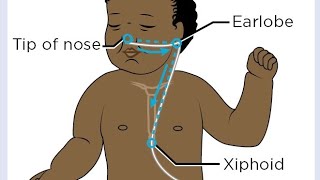 how to insert OG tube Orogastric tube in newborn baby cutebaby newbornbaby hospital nicubaby [upl. by Idnis]