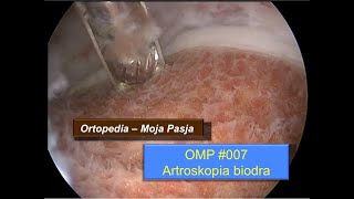 Artroskopia biodra  artroskop przygotowanie procedura i powikłania  OMP 007 [upl. by Savior]