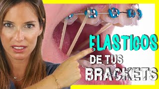 🖍📒ELASTICOS INTERMAXILARES para asentar MORDIDA  Para que sirven las GOMAS de los BRACKETS [upl. by Leid]