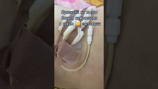 Правильный уход и забота за дренажным катетером  catheter nephrostomy [upl. by Kalk818]