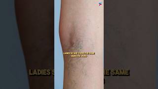 Varicose Veins or Reticular Veins shortfeed veinspecialist spiderveins [upl. by Marder]