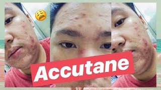 MY ACCUTANE JOURNEY ISOTRETINOIN REVIEW plus 2 MONTH UPDATE amp SIDE EFFECTS [upl. by Crim389]