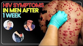 HIV Symptoms in Men After 1 Week [upl. by Ellerahc822]