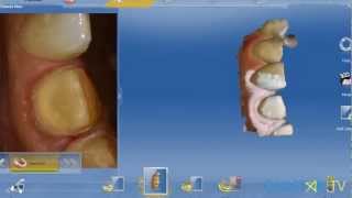 CEREC Omnicam Anterior Application  cadstartv [upl. by Nalat]