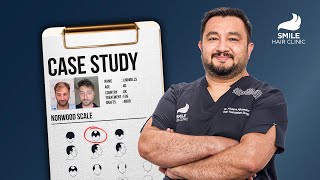 Case Studies 4800 Grafts Transformation  12Month Results with Dr Ahmedov  Hair Transplant [upl. by Kinna245]