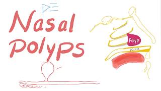 Nasal Polyps Allergic Rhinitis and Cystic Fibrosis [upl. by Oetam]