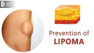 Prevent Lipomas From Occurring  Fatty Lump  Fatty Tumor  Dr Sahebgowda Shetty  Doctors Circle [upl. by Ted75]