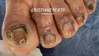 😱 ESTE PROCEDIMENTO SURPREENDEUME satisfatório nails podologia [upl. by Nylorac790]