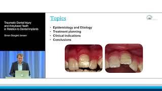 Traumatic Dental Injury and Ankylosed Teeth in Relation to Dental Implants  Simon Storgård Jensen [upl. by Crowell]