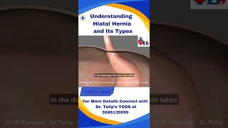 Understanding Hiatal Hernia and Its Types [upl. by Ayotac]