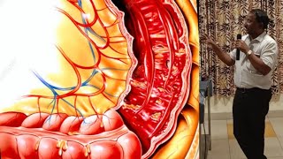 Bacillary Dysentery SHIGELLOSIS [upl. by Artimed]