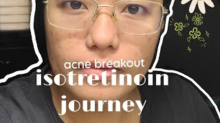 Severe Acne • isotretinoin journey for 2 months acnetreatment [upl. by Israeli330]