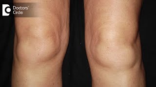 What are the causes of swelling in knees  DrNagesh HS [upl. by Giguere216]