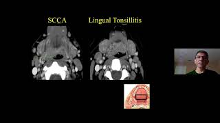 Anatomy amp Pathology of the Oral Cavity amp Oropharynx Dr Suresh Mukherji  MRI Online Noon Conference [upl. by Teahan122]