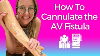 Dialysis Nursing How to Cannulate the AV FISTULA [upl. by Salangia]