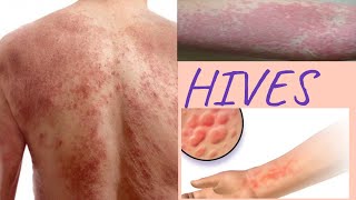 HIVES causes  Natural remedies to get rid of hive at home [upl. by Ocsinarf]