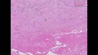 Histopathology AbdomenDesmoid tumor [upl. by Saretta]