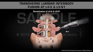 Transverse Lumbar Interbody Fusion at L45 amp L5S1  Medical Animation [upl. by Adaner378]