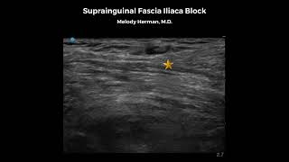 Suprainguinal Fascia Iliaca Block [upl. by Bergstein359]