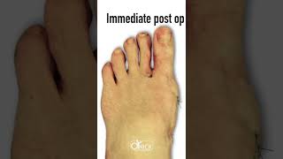 Minimally Invasive Bunion Surgery Before and After shorts [upl. by Akeylah]