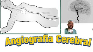 Angiografia Cerebral o que é [upl. by Oigroeg368]