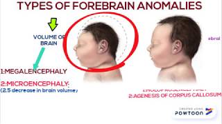 Forebrain anomalies part 1 [upl. by Erleena347]