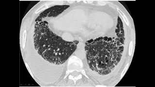 Desquamative interstitial pneumonia [upl. by Ogir]