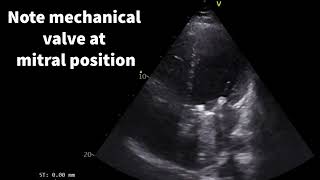 Prosthetic valve dysfunction [upl. by Leahkim53]