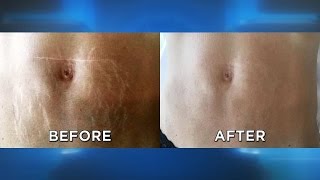 Does This Stretch Mark Removal Procedure Work [upl. by Jamilla]