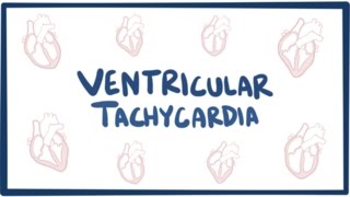 Ventricular tachycardia VT  causes symptoms diagnosis treatment amp pathology [upl. by Rolland]