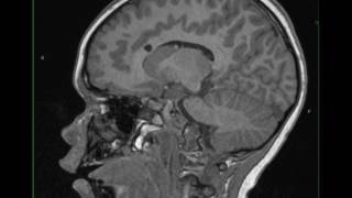 Tuberous Sclerosis with Subependymal Giant Cell Astrocytoma [upl. by Alleon]