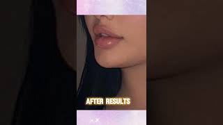 Lip Filler Treatment results in BandraMumbai [upl. by Lorrin]