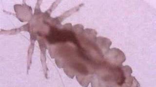 Head Lice [upl. by Hervey]