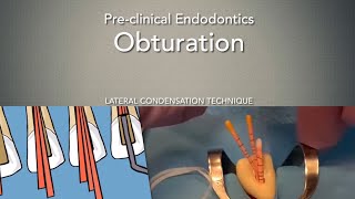 Obturation Lateral Condensation Technique [upl. by Ariat]