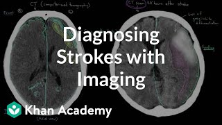 Diagnosing strokes with imaging CT MRI and Angiography  NCLEXRN  Khan Academy [upl. by Ahsiak]