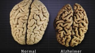 Understanding Alzheimers Disease dementia alzheimer [upl. by Mona231]