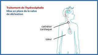 Hydrocéphalie  valve de dérivation cardiaque [upl. by Aiclef]