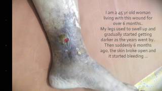 Venous Ulcer Success Story [upl. by Aninahs]